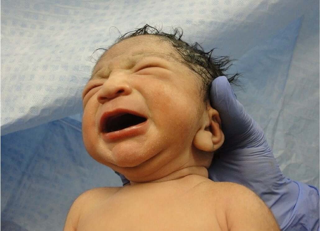 What is a birth injury?
